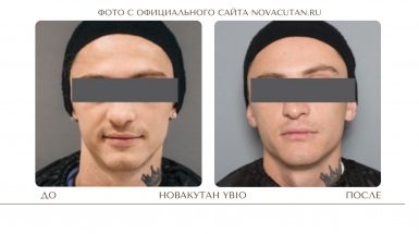 До и после: Биоревитализация Новакутан / NOVACUTAN