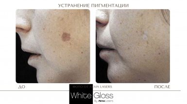 До и после: Пигментные пятна на теле и лице