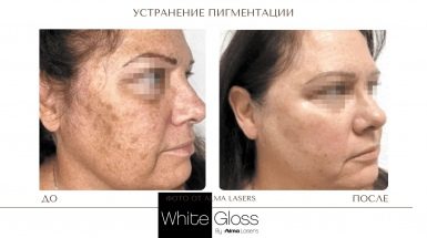 До и после: Пигментные пятна на теле и лице