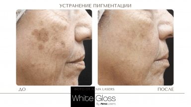 До и после: Пигментные пятна на теле и лице
