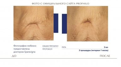 До и после: Процедура Профайло / PROFHILO для омоложения лица
