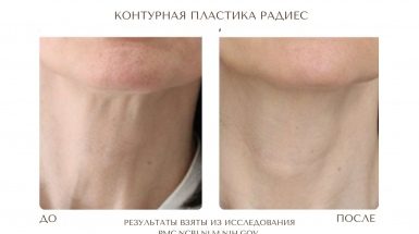 До и после: Контурная пластика Радиес / Radiesse