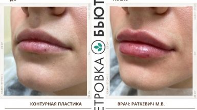 До и после: Шарики в губах после увеличения