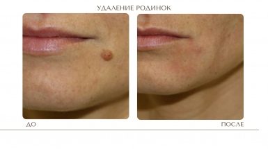 До и после: Лазерное удаление родинок в Москве