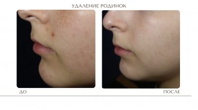 Лазерное удаление родинок в Москве