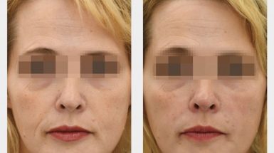 До и после: Биоревитализант RRS® HA LONG LASTING