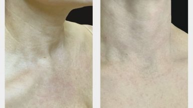 До и после: Биоревитализант RRS® HA LONG LASTING