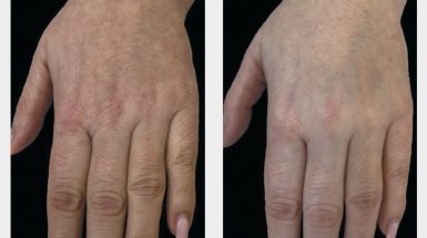 До и после: Биоревитализант RRS® HA LONG LASTING