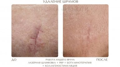 До и после: Лазерная шлифовка и удаление шрамов и рубцов