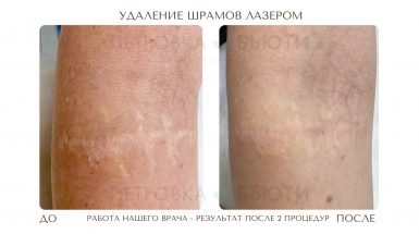 До и после: Лазерная шлифовка и удаление шрамов и рубцов