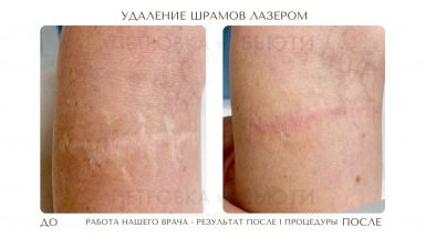 До и после: Лазерная шлифовка и удаление шрамов и рубцов