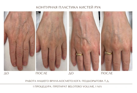 До и после: Контурная пластика Радиес / Radiesse, врач Подкорытова Т. Д., через 1 месяц после процедуры