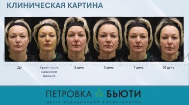 До и после: Ретиноловый пилинг Тизо (Tizo)
