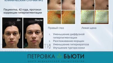 До и после: Ретиноловый пилинг Тизо (Tizo)
