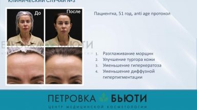 До и после: Ретиноловый пилинг Тизо (Tizo)