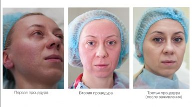 До и после: Фракционный фототермолиз Фраксель (Fraxel)