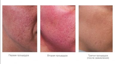 До и после: Фракционный фототермолиз Фраксель (Fraxel)