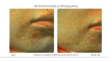 До и после: Фототерапия от пигментных пятен