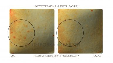 До и после: Фототерапия от пигментных пятен