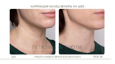 До и после: Кольца Венеры на шее