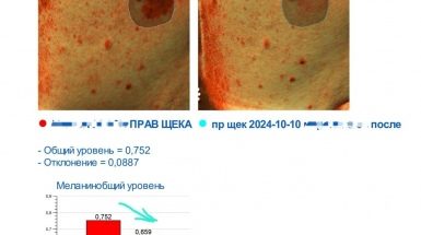 До и после: Удаление пигментных пятен лазером, врач Громыко Н. Ч.