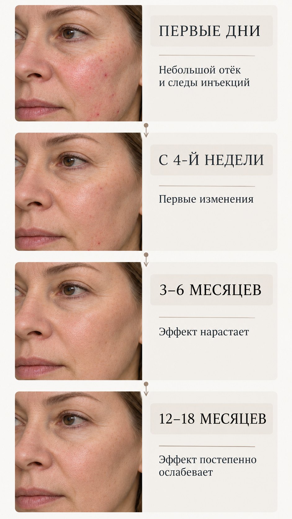 Хронология эффекта полимолочной кислоты от первых дней после процедуры до 12–18 месяцев.